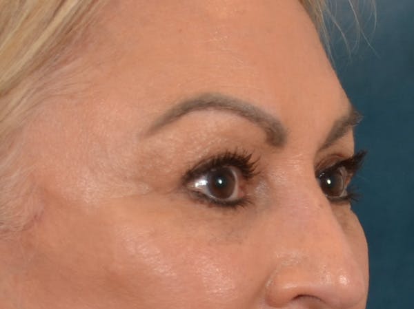 Eyelid Lift Before & After Gallery - Patient 430420 - Image 4