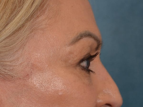 Eyelid Lift Before & After Gallery - Patient 430420 - Image 6