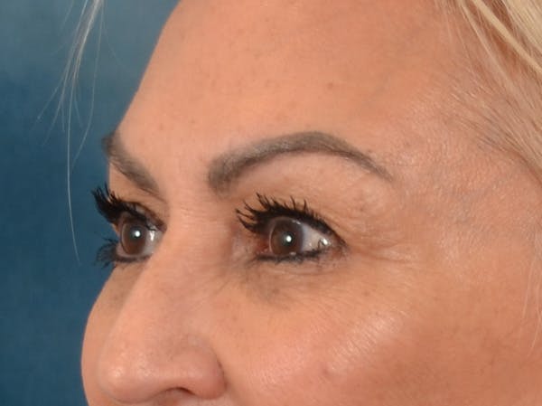 Eyelid Lift Before & After Gallery - Patient 430420 - Image 7