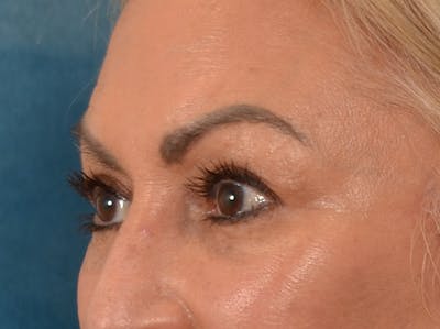 Eyelid Lift Before & After Gallery - Patient 430420 - Image 8
