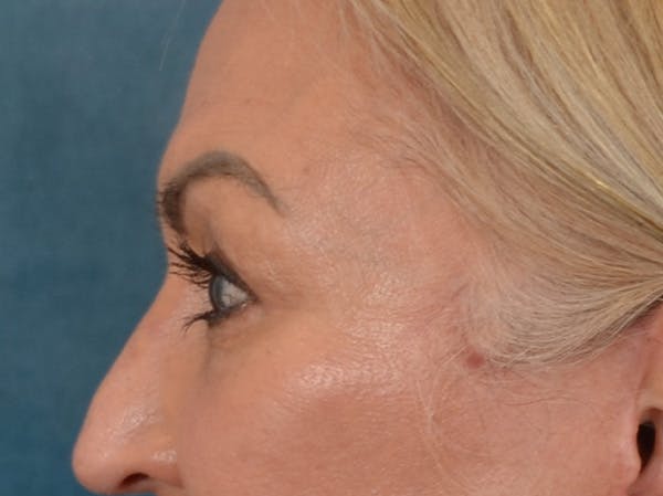 Eyelid Lift Before & After Gallery - Patient 430420 - Image 10
