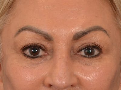 Eyelid Lift Before & After Gallery - Patient 430420 - Image 2