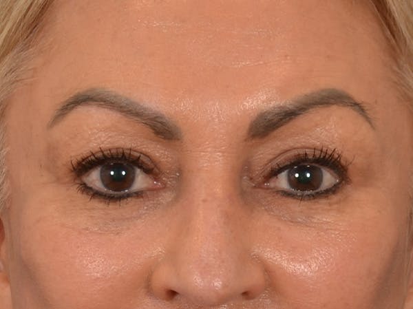 Eyelid Lift Before & After Gallery - Patient 430420 - Image 2