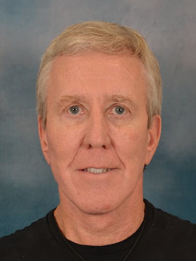 Fat Transfer Before & After Gallery - Patient 224040 - Image 2