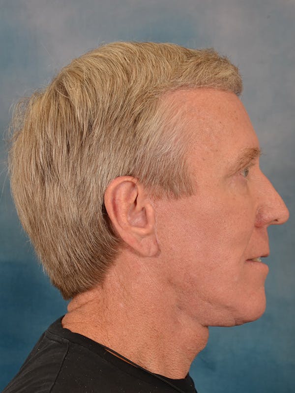 Fat Transfer Before & After Gallery - Patient 224040 - Image 6