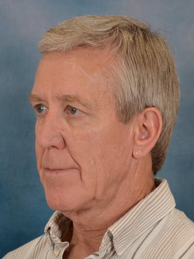 Deep Plane Facelift Before & After Gallery - Patient 352780 - Image 1