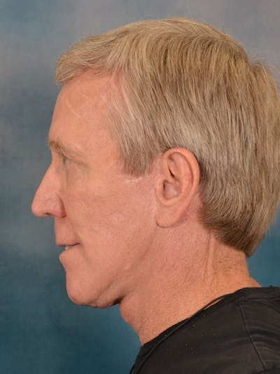 Fat Transfer Before & After Gallery - Patient 224040 - Image 10