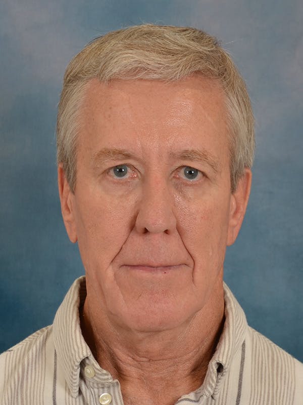 Fat Transfer Before & After Gallery - Patient 224040 - Image 1