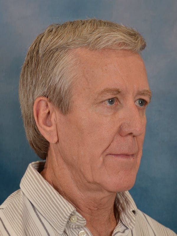 Fat Transfer Before & After Gallery - Patient 224040 - Image 3