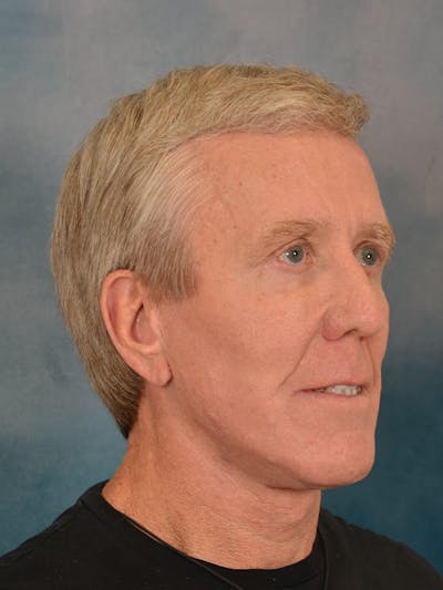 Fat Transfer Before & After Gallery - Patient 224040 - Image 4