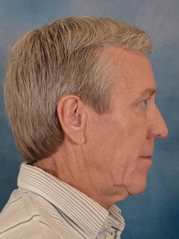 Fat Transfer Before & After Gallery - Patient 224040 - Image 5