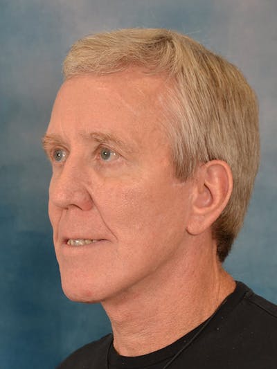 Fat Transfer Before & After Gallery - Patient 224040 - Image 8