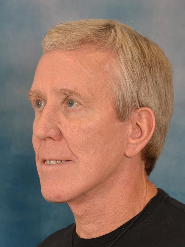 Fat Transfer Before & After Gallery - Patient 224040 - Image 8