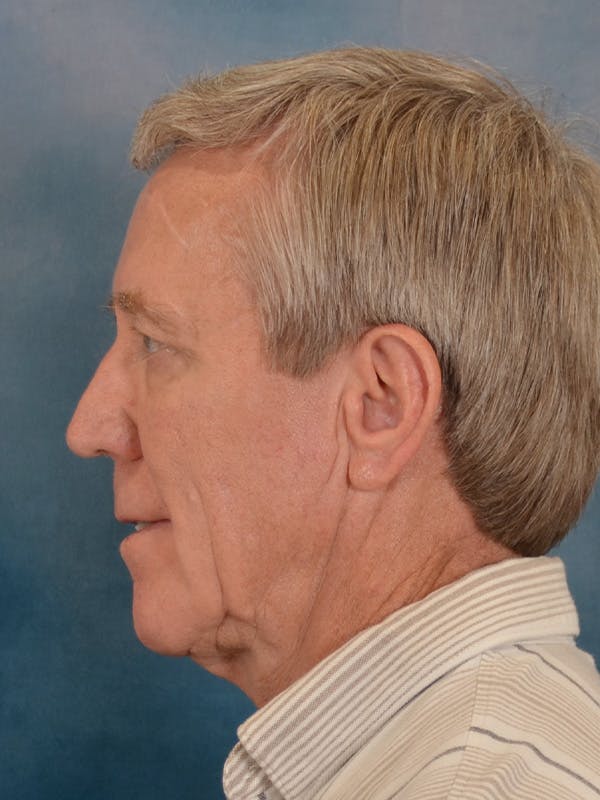 Fat Transfer Before & After Gallery - Patient 224040 - Image 9