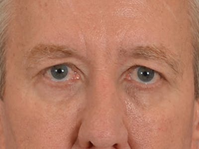Eyelid Lift Before & After Gallery - Patient 362124 - Image 1