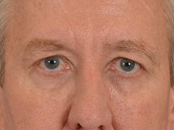 Eyelid Lift Before & After Gallery - Patient 362124 - Image 1