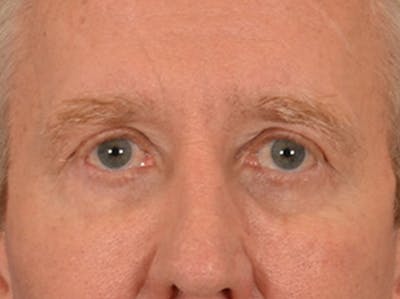 Eyelid Lift Before & After Gallery - Patient 362124 - Image 2