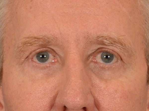 Eyelid Lift Before & After Gallery - Patient 362124 - Image 2