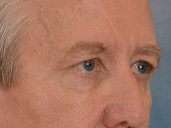 Eyelid Lift Before & After Gallery - Patient 362124 - Image 3