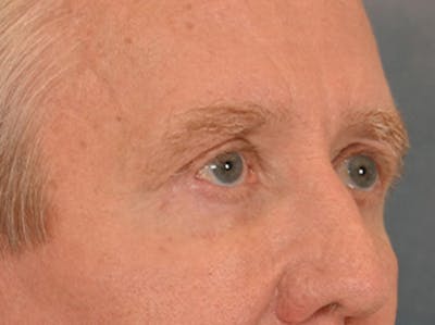 Eyelid Lift Before & After Gallery - Patient 362124 - Image 4