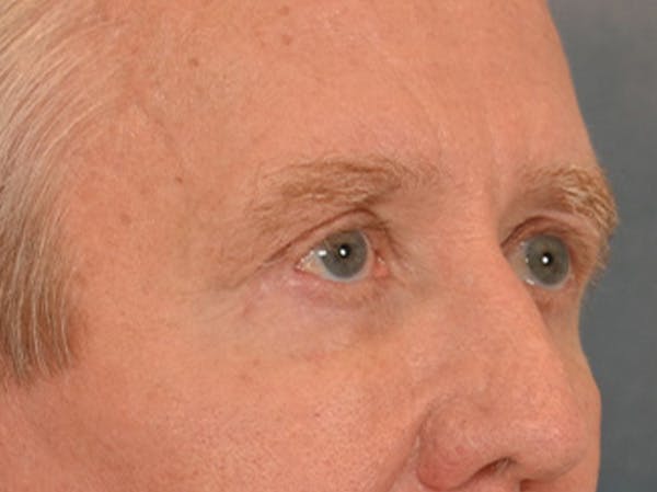 Eyelid Lift Before & After Gallery - Patient 362124 - Image 4