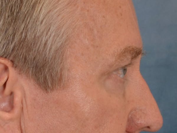 Eyelid Lift Before & After Gallery - Patient 362124 - Image 5
