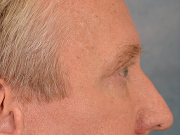 Eyelid Lift Before & After Gallery - Patient 362124 - Image 6