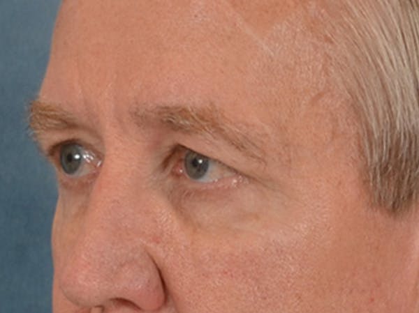 Eyelid Lift Before & After Gallery - Patient 362124 - Image 7