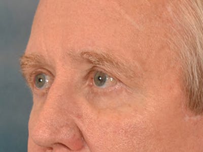 Eyelid Lift Before & After Gallery - Patient 362124 - Image 8