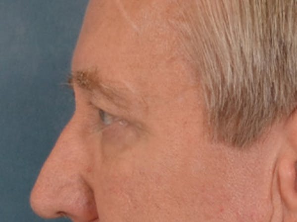 Eyelid Lift Before & After Gallery - Patient 362124 - Image 9