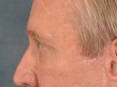 Eyelid Lift Before & After Gallery - Patient 362124 - Image 10