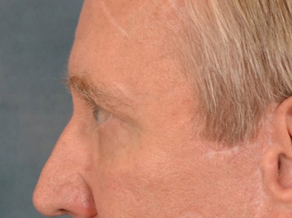 Eyelid Lift Before & After Gallery - Patient 362124 - Image 10