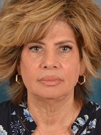 Deep Neck Lift Before & After Gallery - Patient 748290 - Image 1