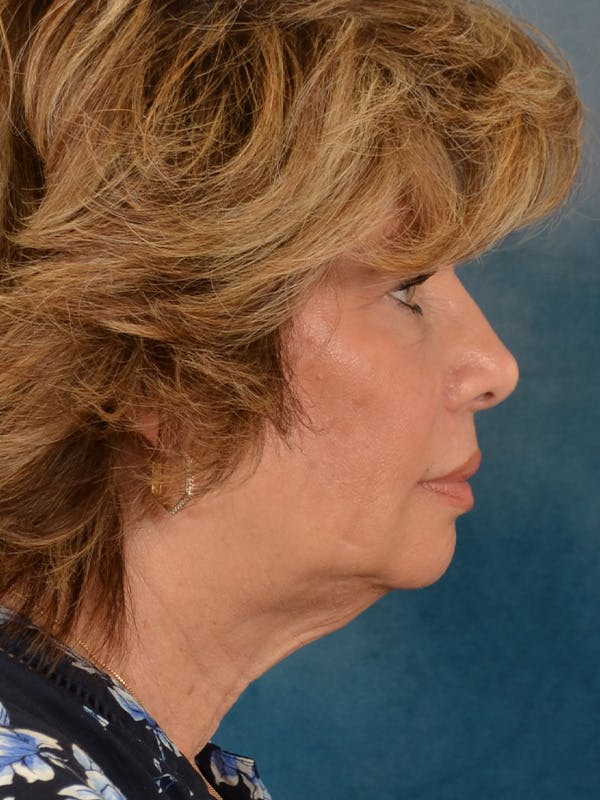 Deep Neck Lift Before & After Gallery - Patient 748290 - Image 9