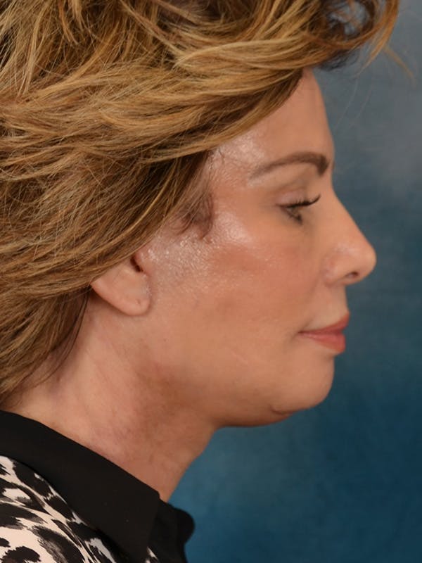 Deep Neck Lift Before & After Gallery - Patient 748290 - Image 10