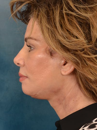 Deep Neck Lift Before & After Gallery - Patient 748290 - Image 6