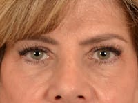 Eyelid Lift Before & After Gallery - Patient 191416 - Image 1