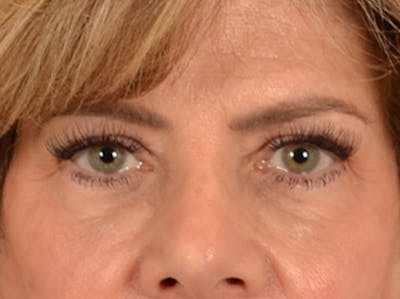 Eyelid Lift Before & After Gallery - Patient 191416 - Image 1