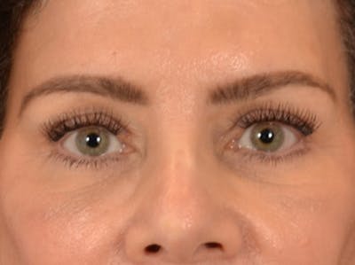 Eyelid Lift Before & After Gallery - Patient 191416 - Image 2