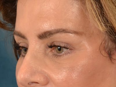 Eyelid Lift Before & After Gallery - Patient 191416 - Image 8