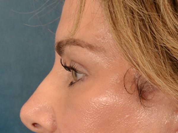 Eyelid Lift Before & After Gallery - Patient 191416 - Image 10