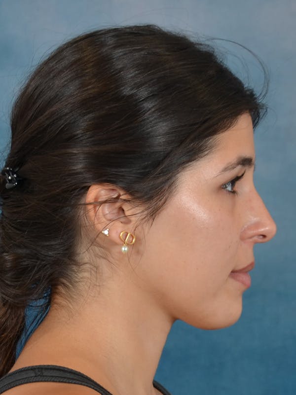 Rhinoplasty Before & After Gallery - Patient 409507 - Image 9