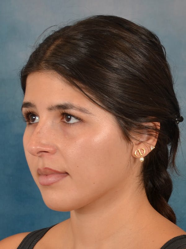 Rhinoplasty Before & After Gallery - Patient 409507 - Image 3