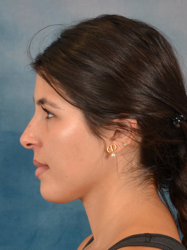 Rhinoplasty Before & After Gallery - Patient 409507 - Image 1