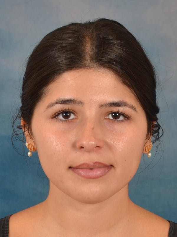 Rhinoplasty Before & After Gallery - Patient 409507 - Image 5