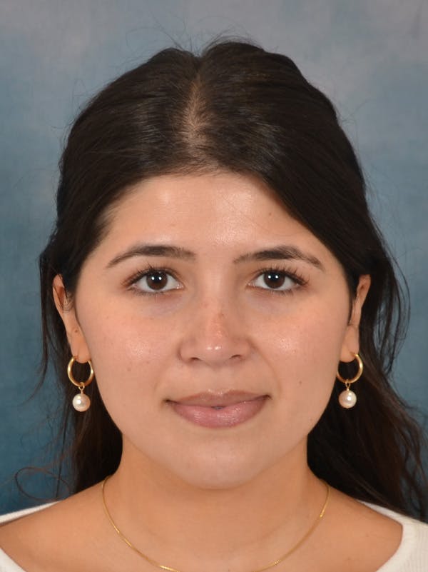 Rhinoplasty Before & After Gallery - Patient 409507 - Image 6