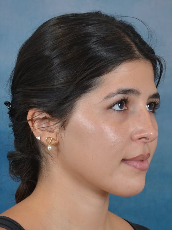 Rhinoplasty Before & After Gallery - Patient 409507 - Image 7
