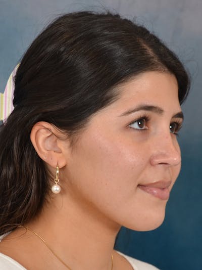 Rhinoplasty Before & After Gallery - Patient 409507 - Image 8