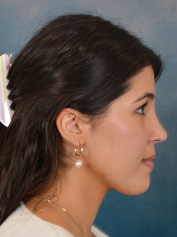 Rhinoplasty Before & After Gallery - Patient 409507 - Image 10