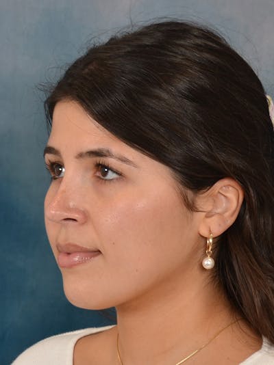 Rhinoplasty Before & After Gallery - Patient 409507 - Image 4